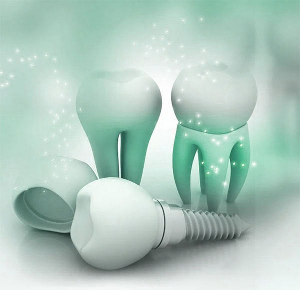 Implantes Dentales sin Tornillo | Clínica Dental Satorres - Paterna - Manises