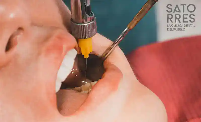 Implementación anestesia local | Clínica Dental Satorres