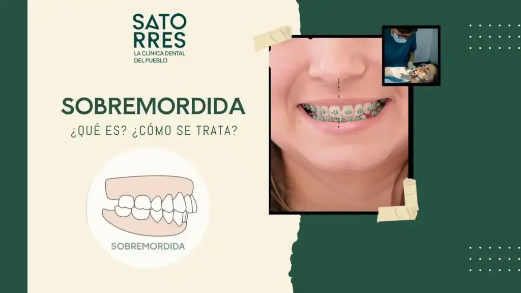 Banner que es sobremordida | Clínica Dental Satorres - Paterna - Manises