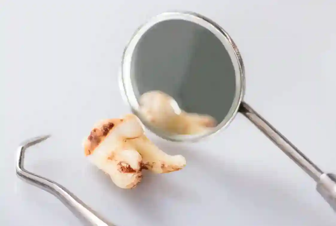 Diente con Caries Dental | Clinica Dental Satorres