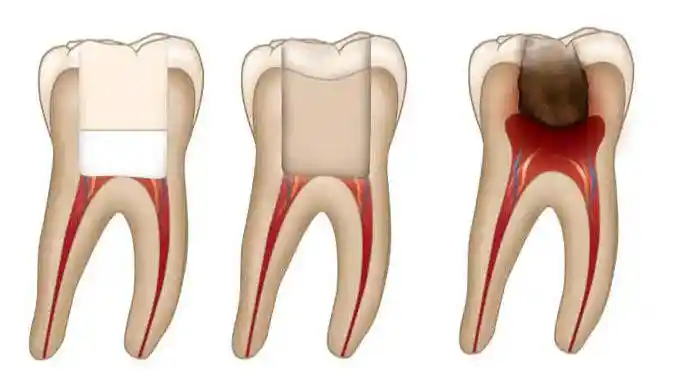 Esquema Pulpotomía | Clinica Dental Satorres