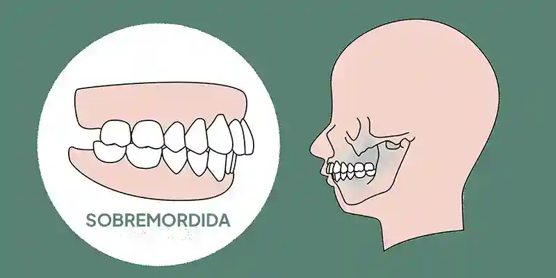 Esquema Sobremordida | Clínica Dental Satorres - Paterna - Manises