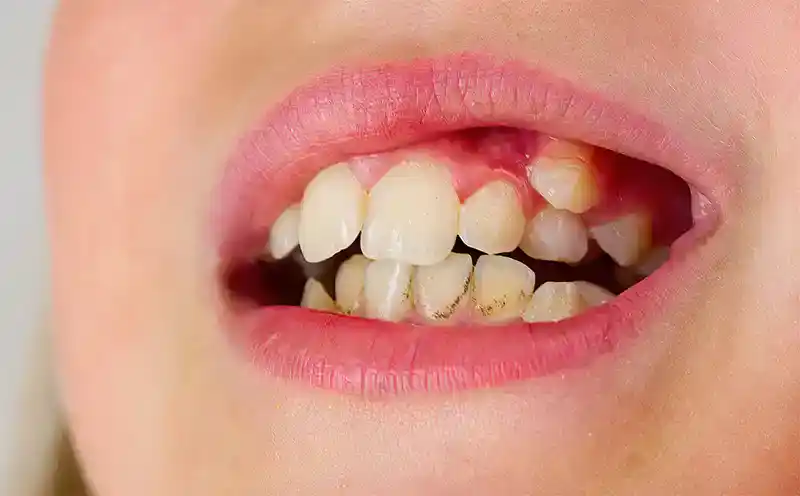 Sobremordida infantil | Clínica Dental Satorres - Paterna - Manises