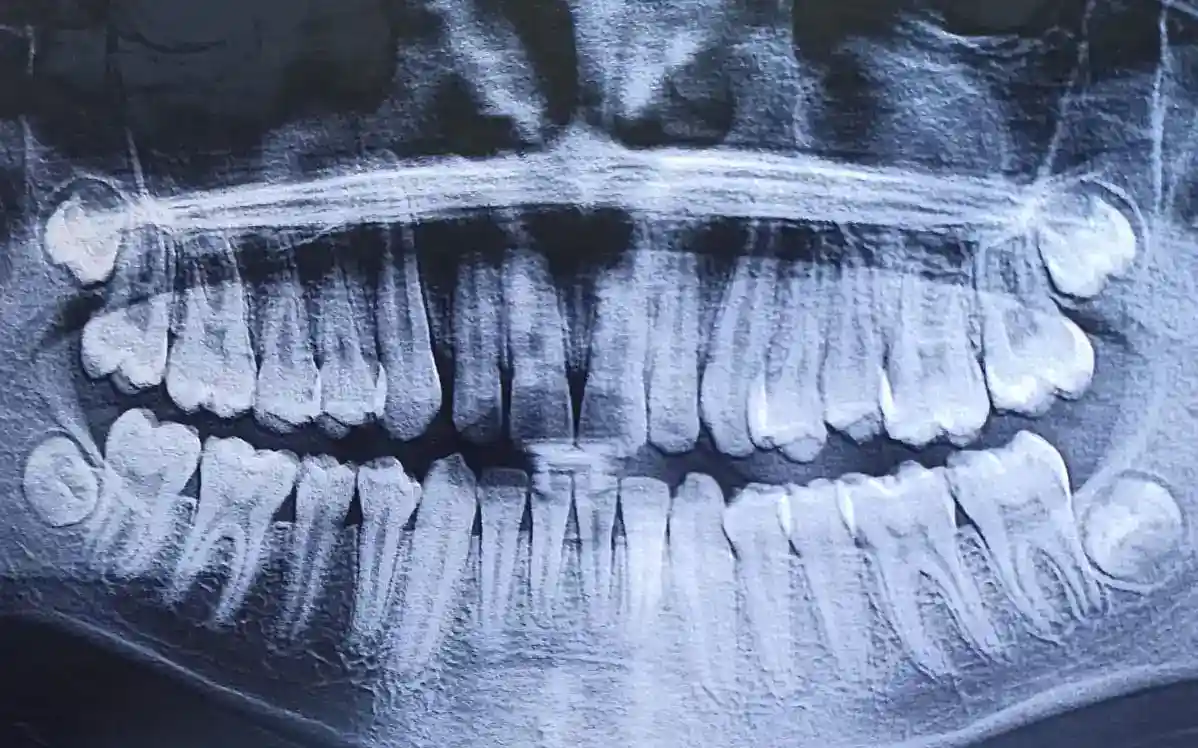 Radiografía Caries | Clinica Dental Satorres