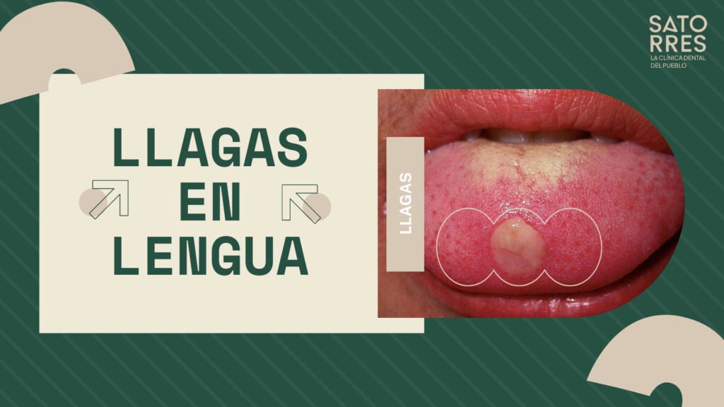 Banner Llagas en la lengua | Clinica Dental Satorres