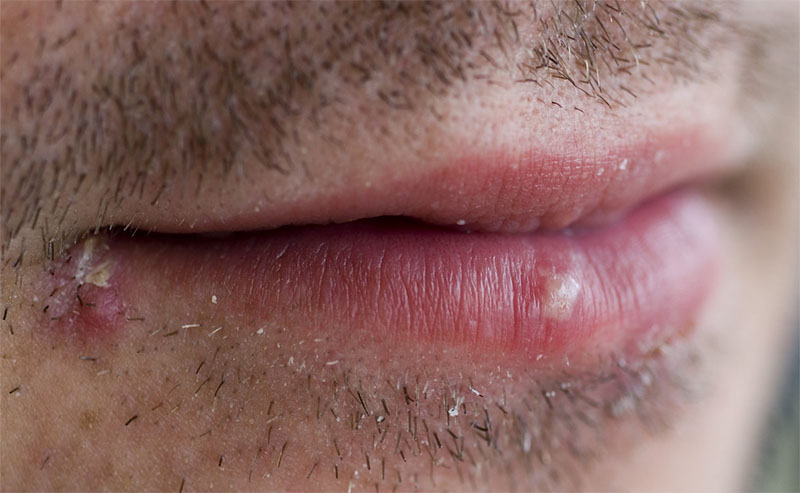 Herpes y Llagas en la lengua | Clinica Dental Satorres