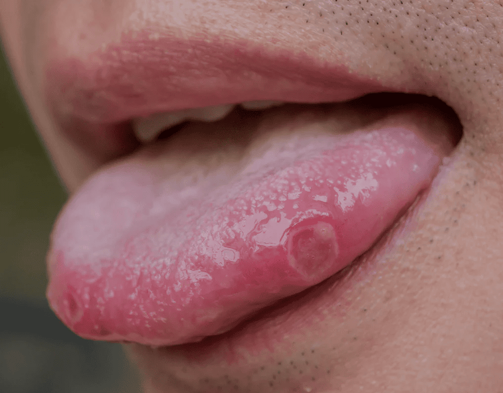 Llagas en la lengua | Clinica Dental Satorres
