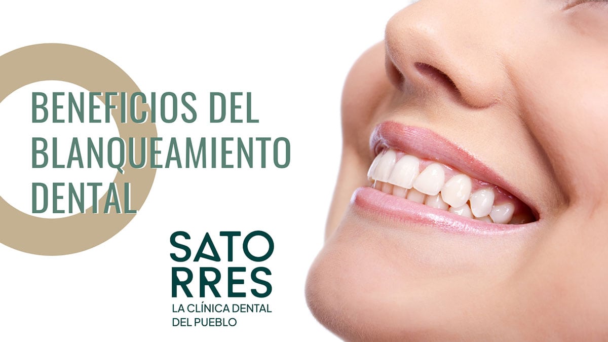 Beneficios del Blanqueamiento Dental