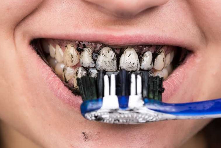 Cuidado Blanqueamiento Dental Casero | Clínica Dental Satorres