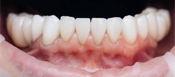Fijación Carillas y esmalte Dental | Clínica Dental Satorres - Paterna Manises