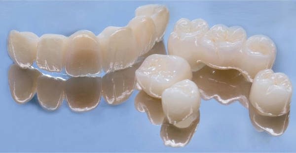Cerámica Carillas y esmalte Dental | Clínica Dental Satorres - Paterna Manises