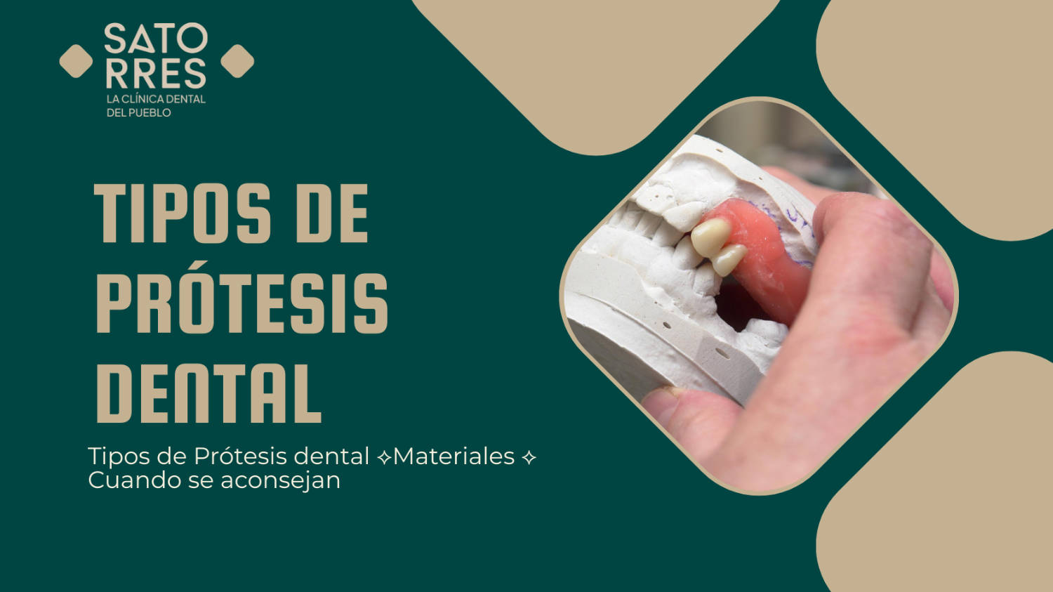 Tipos de prótesis dental. Materiales. Cuando se aconsejan.