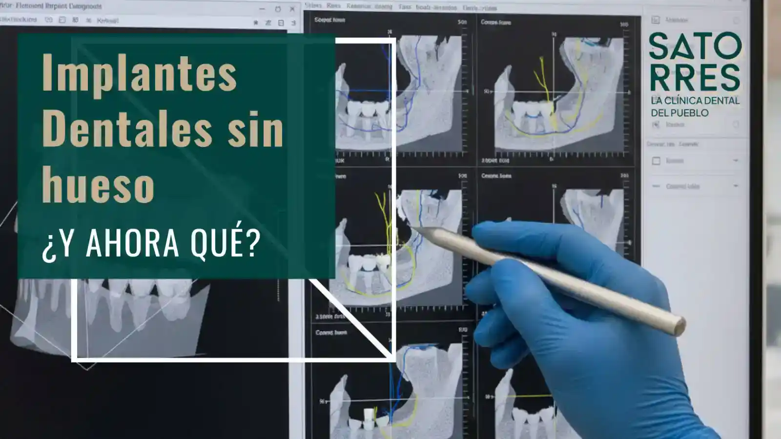 Implantes dentales si tengo poco hueso… ¿Es posible?