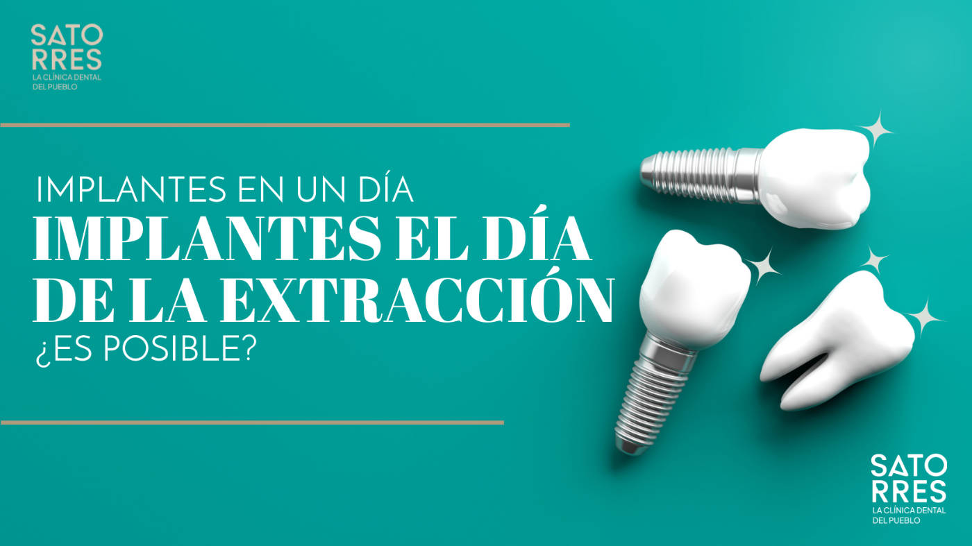 Implantes en un día tras la extracción, ¿Se puede?