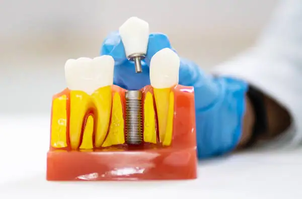 Evolución Coronas Dentales | Clínica Dental Satorres